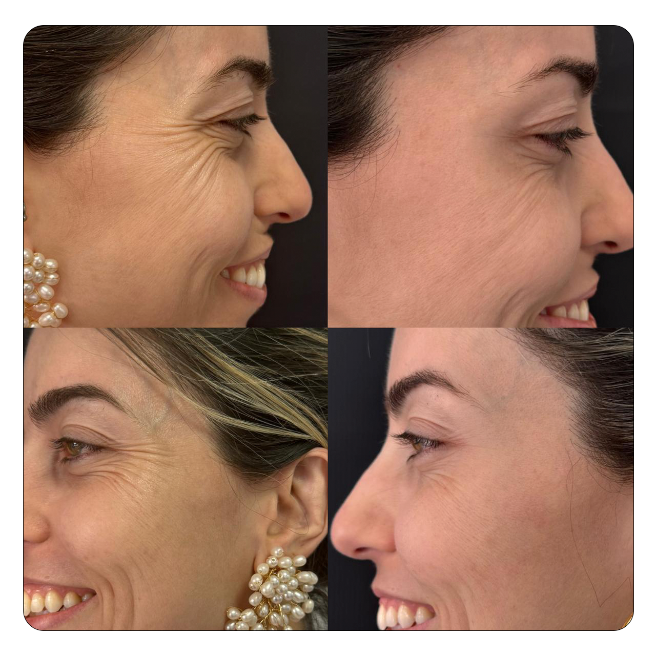 Natural Face - Resultado 3