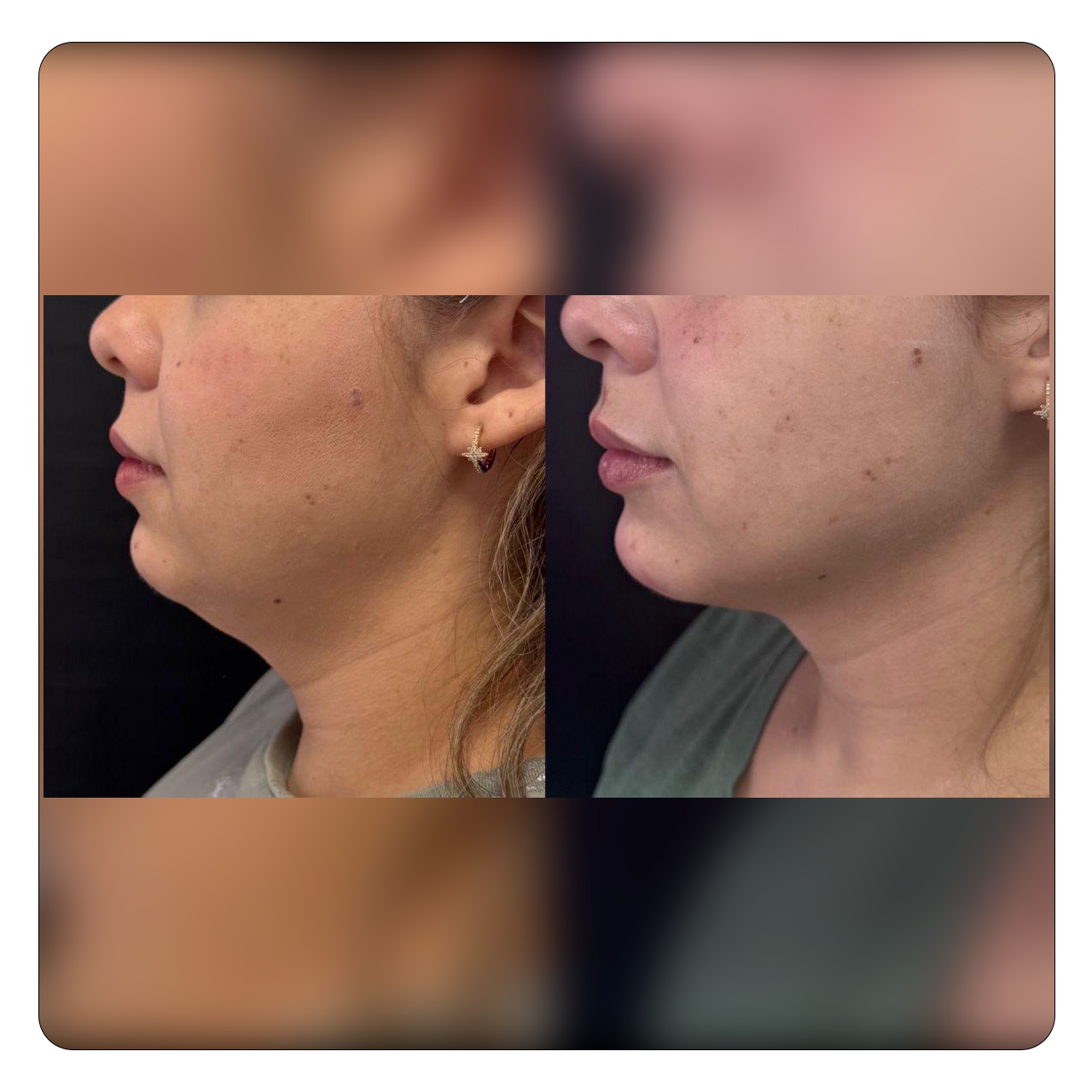 Natural Face - Resultado 5
