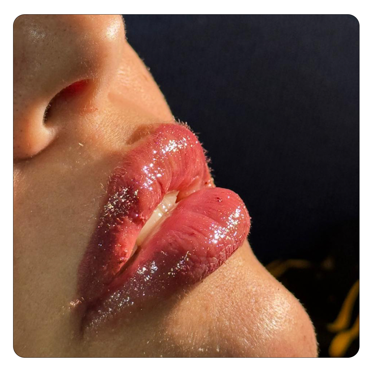 Preenchimento Labial - Resultado 1