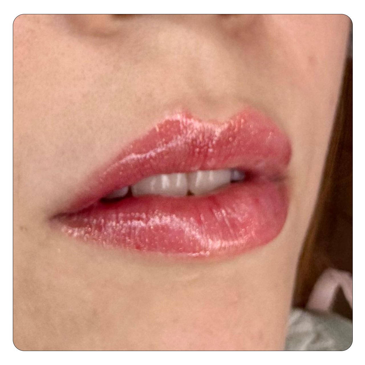 Preenchimento Labial - Resultado 2