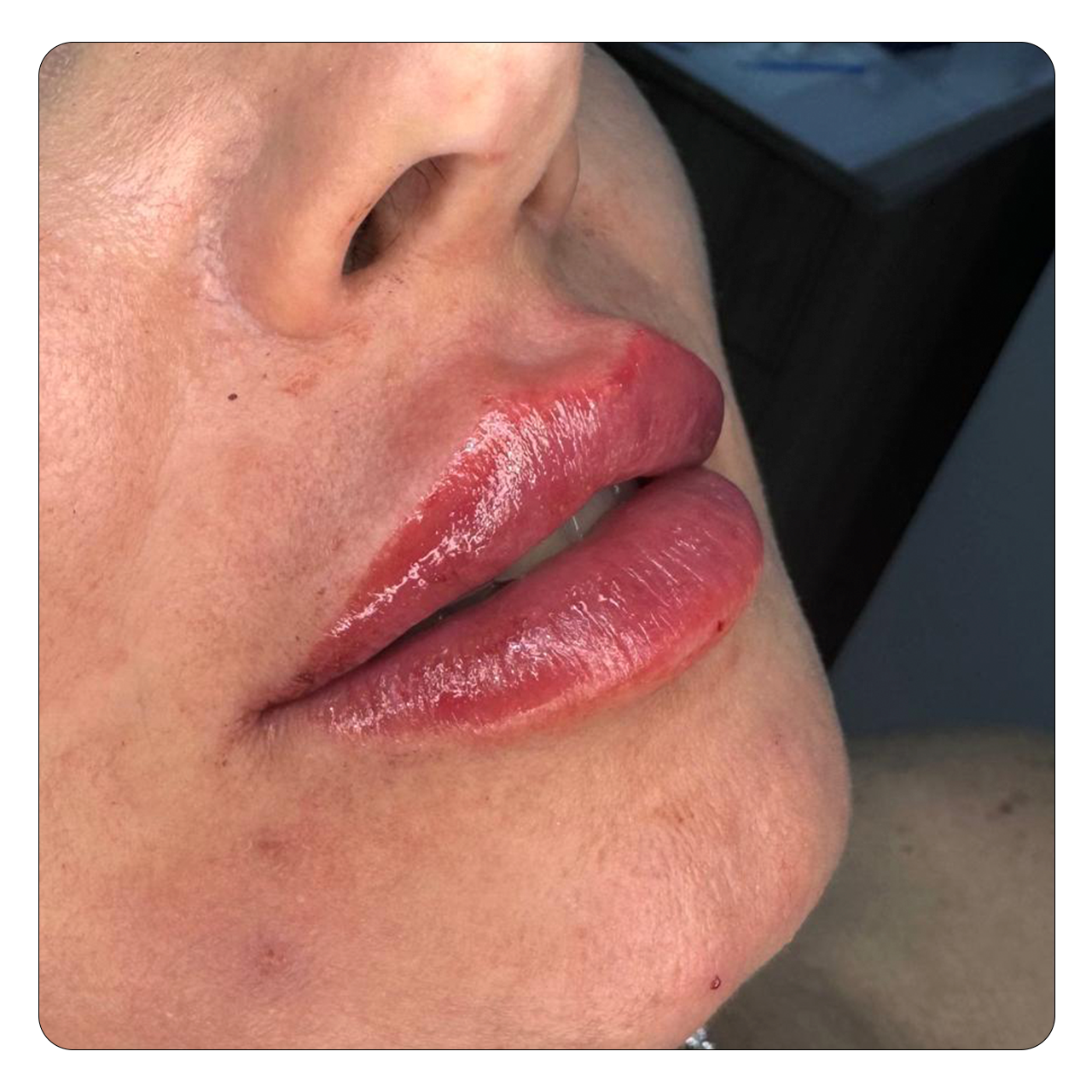 Preenchimento Labial - Resultado 5