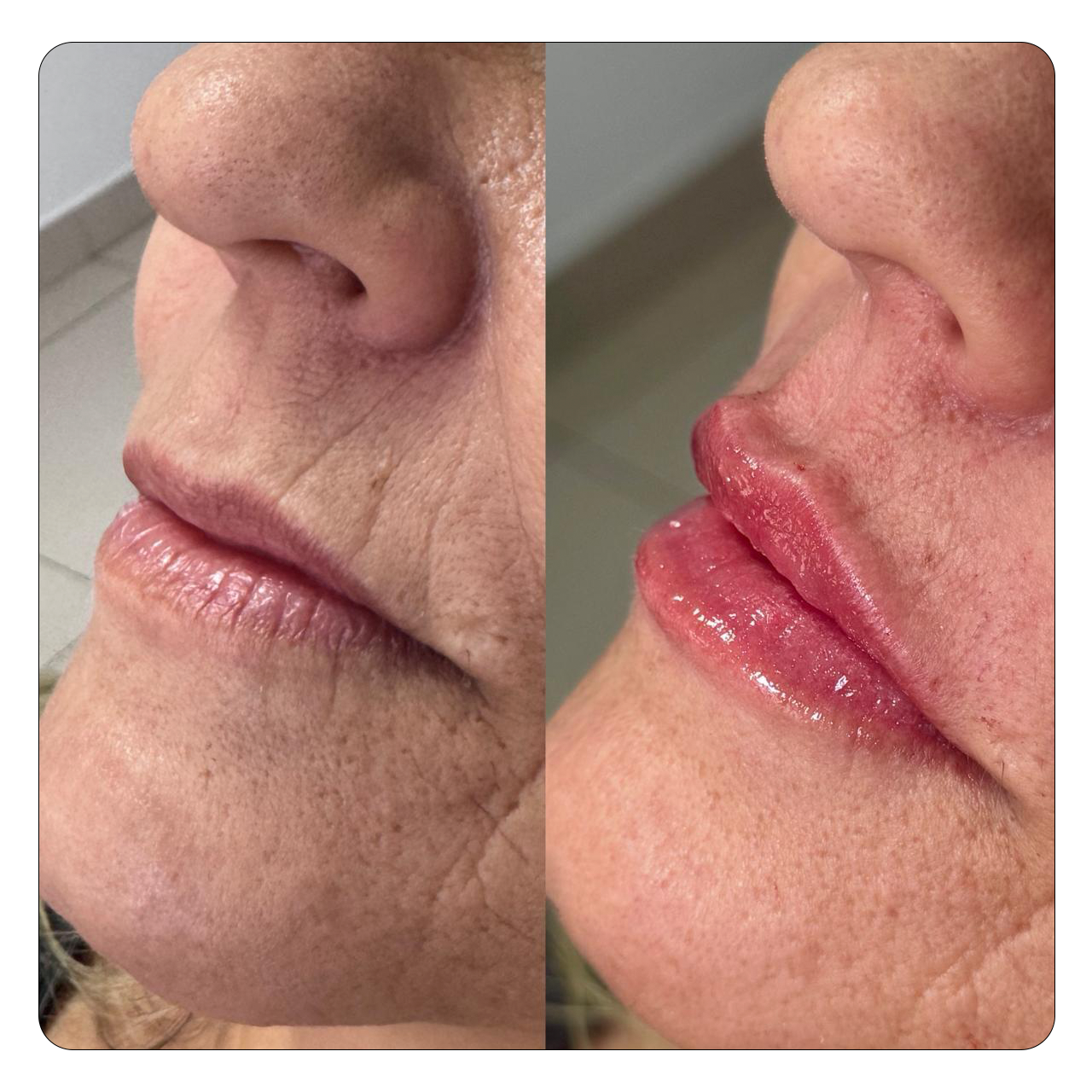 Preenchimento Labial - Resultado 6